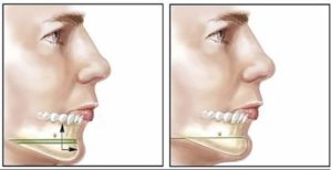 chin surgery colombia
