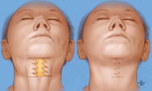 neck rejuvenation colombia