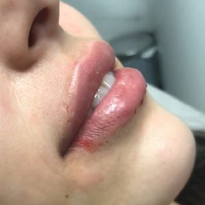 Colombia lip filler
