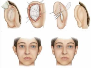 ear surgery colombia