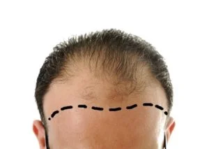COLOMBIA HAIR IMPLANT