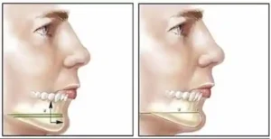 Chin surgery Colombia