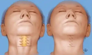 neck lift colombia