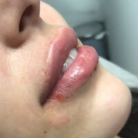Lip Augmentation Colombia lip filler