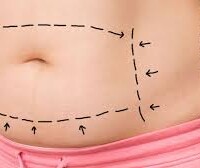 Abdominoplasty abdominoplasty colombia
