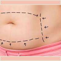 Abdominoplasty abdominoplasty colombia