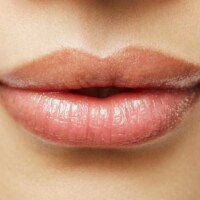 lip augmentation colombia