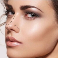 Rhinoplasty rhinoplasty